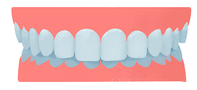 malocclusie of onderkaak retrognathie